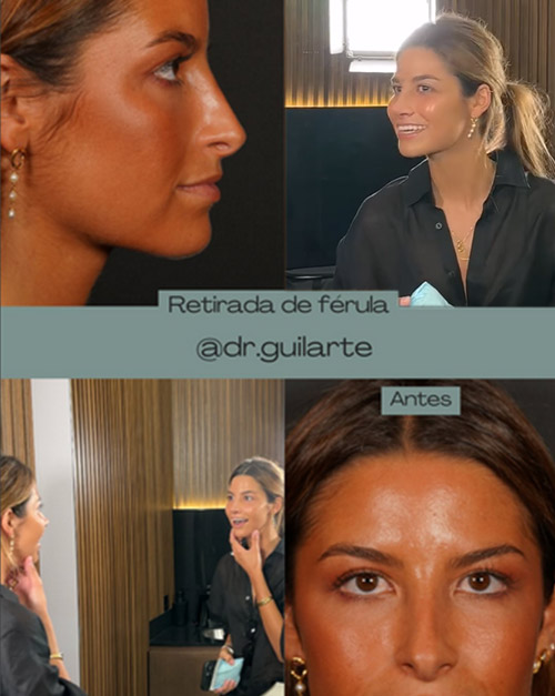 Reacción de la paciente tras la retirada de la férula despues de la rinoplastia (Foto 1)