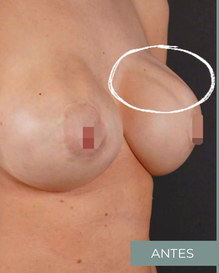 Solucionar rippling provocado por los implantes mamarios en posición subglandular foto 1 de 2 (antes) Solucionar rippling provocado por los implantes mamarios en posición subglandular foto 1 de 2 (antes)
