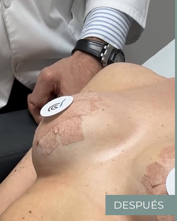 Solucionar rippling provocado por los implantes mamarios en posición subglandular foto 2 de 2 (después) Solucionar rippling provocado por los implantes mamarios en posición subglandular foto 2 de 2 (después)