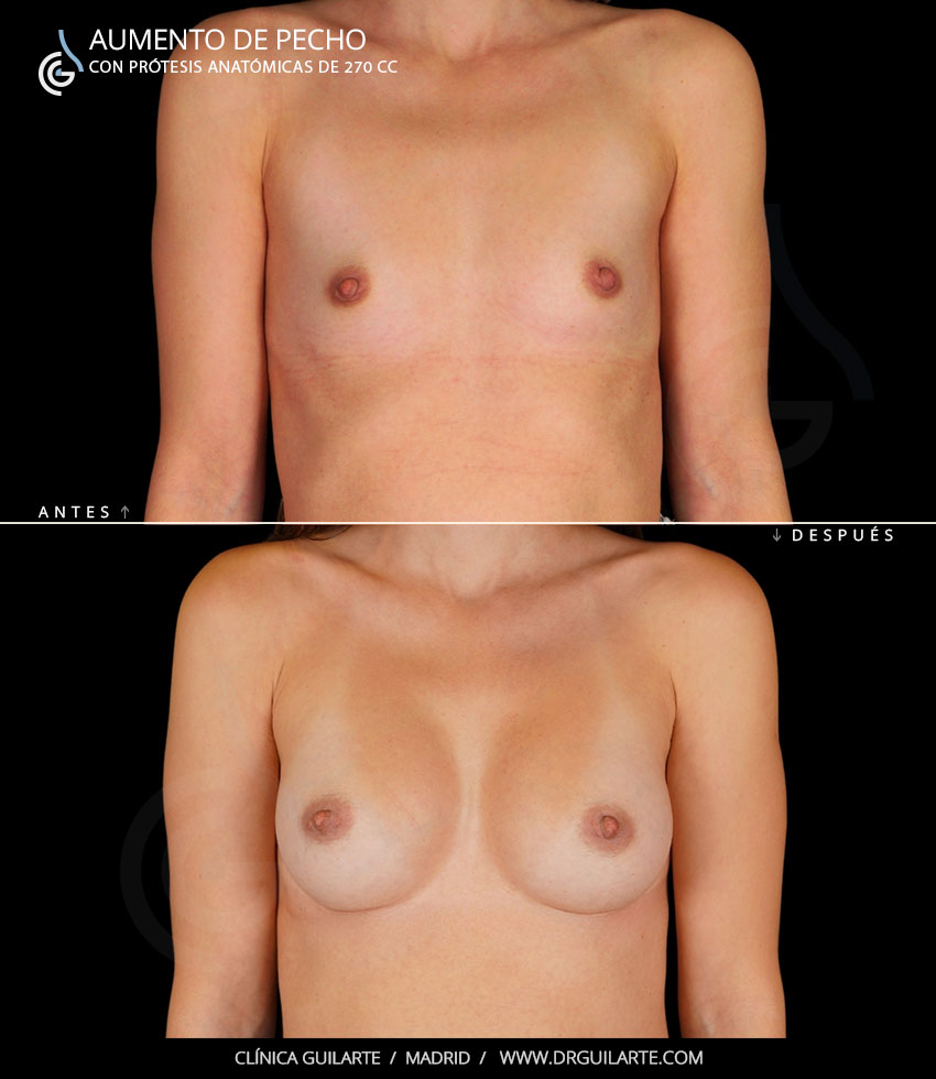 Resultado de aumento de pecho, bonito y natural 1 Resultado de aumento de pecho, bonito y natural 1
