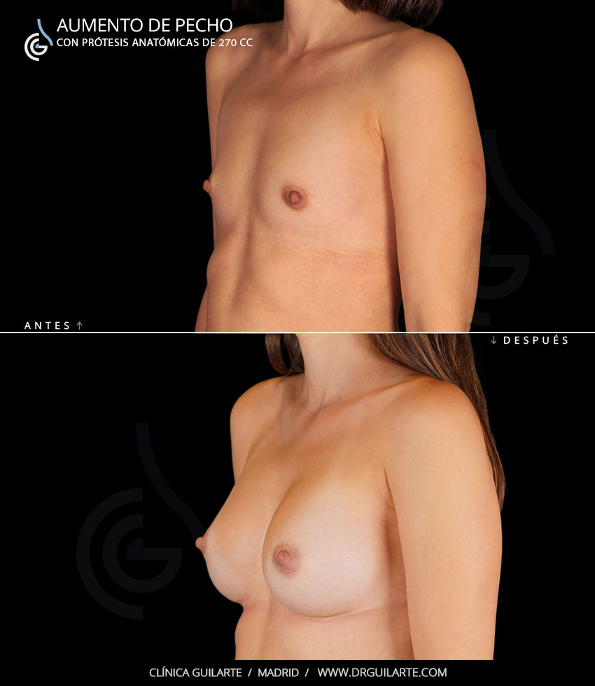 Resultado de aumento de pecho, bonito y natural 4 Resultado de aumento de pecho, bonito y natural 4