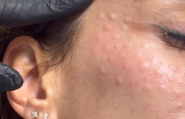 Mesoterapia facial, pápulas que desaparecen en 2-3 h. Mesoterapia facial, pápulas que desaparecen en 2-3 h.