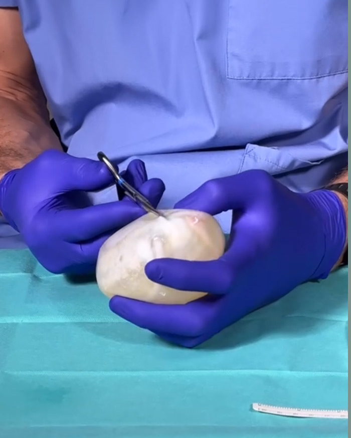Diseccionando un implante mamario que ha sufrido una contractura capsular Diseccionando un implante mamario que ha sufrido una contractura capsular