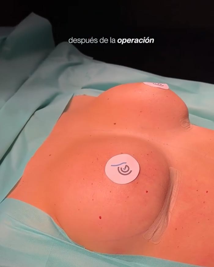 Aumento de pecho con prótesis redondas, mujer operada en la Clínica Guilarte, resultado inmediato después de la operación Aumento de pecho con prótesis redondas, mujer operada en la Clínica Guilarte, resultado inmediato después de la operación