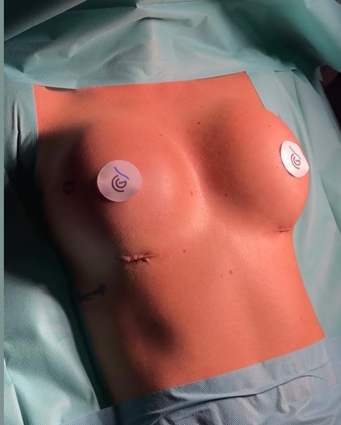 ciicatriz-del-pecho-recien-operado-en-la-clinica-guilarte